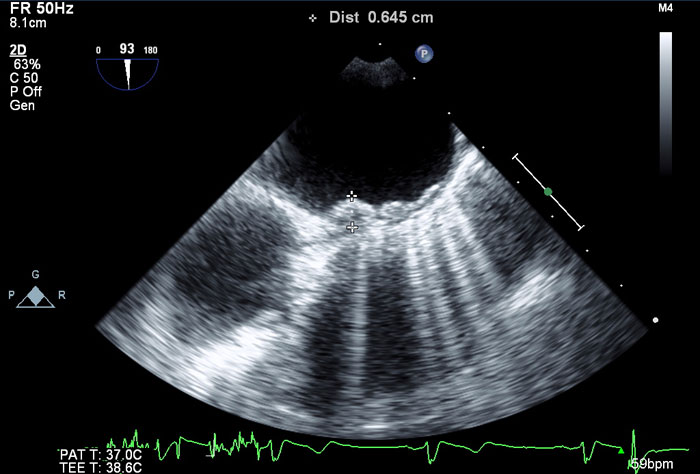 aortic_atheroma